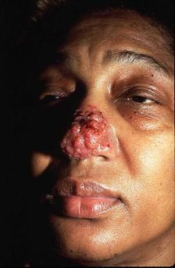 blastomycosis infection of the nose