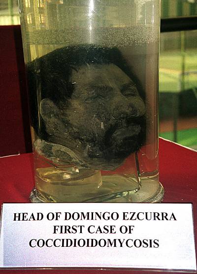 preserved head of Domingo Ezcurra, first patient diagnosed with Coccidioidomycosis