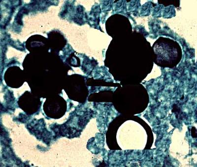 Paracoccidioides in biopsy of meninges (lining of the brain) -- Steamboat Willie