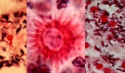 yeast, asteroid body, cigar bodies in Histopathology of sporotrichosis